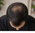 Crown Balding