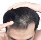 DHT Hair Loss