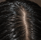 Oily Scalp