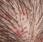 Scalp Inflammation